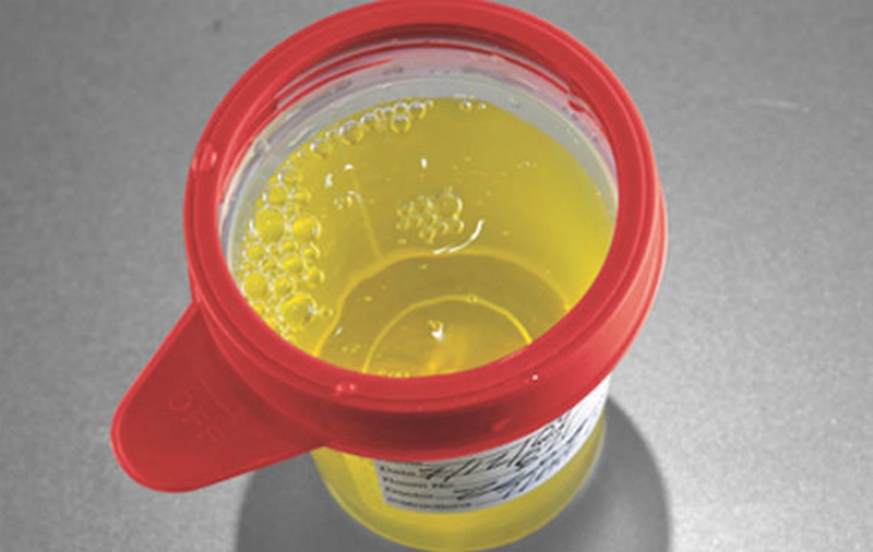 Lý giải hiện tượng nước tiểu đục có cặn trắng 3