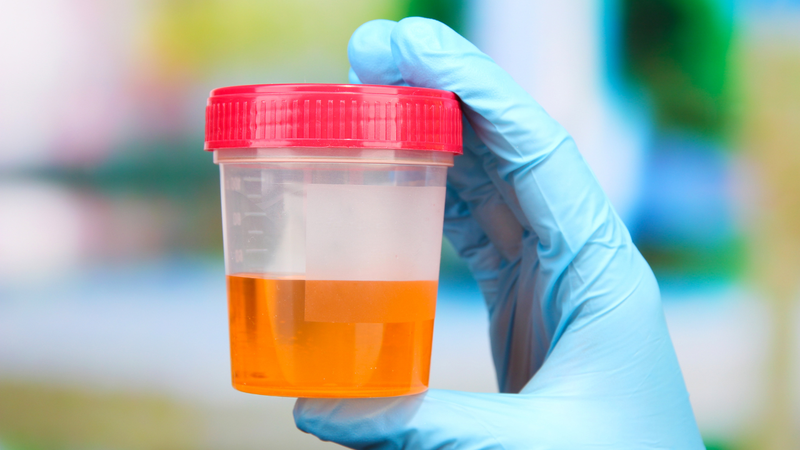 Nước tiểu màu cam có thể là tín hiệu sớm của nhiều bệnh lý