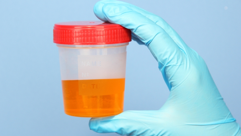 Nước tiểu màu gì là tốt? Màu sắc nước tiểu phản ánh tình trạng sức khỏe như thế nào? 3