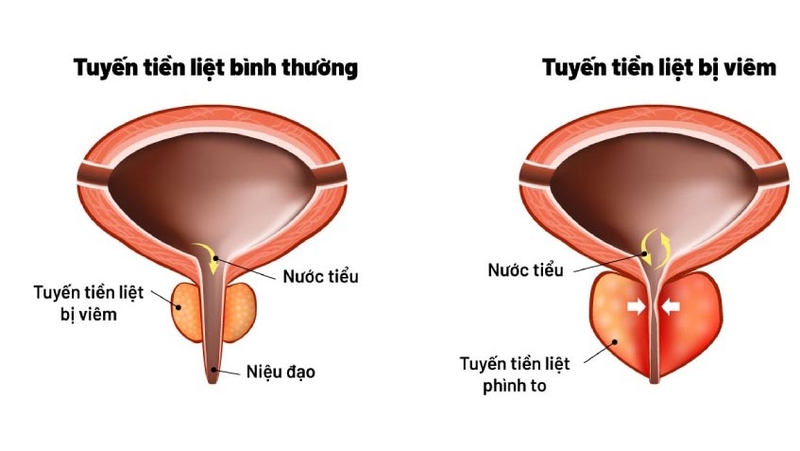 Nước tiểu màu trắng đục là bị bệnh gì?  5