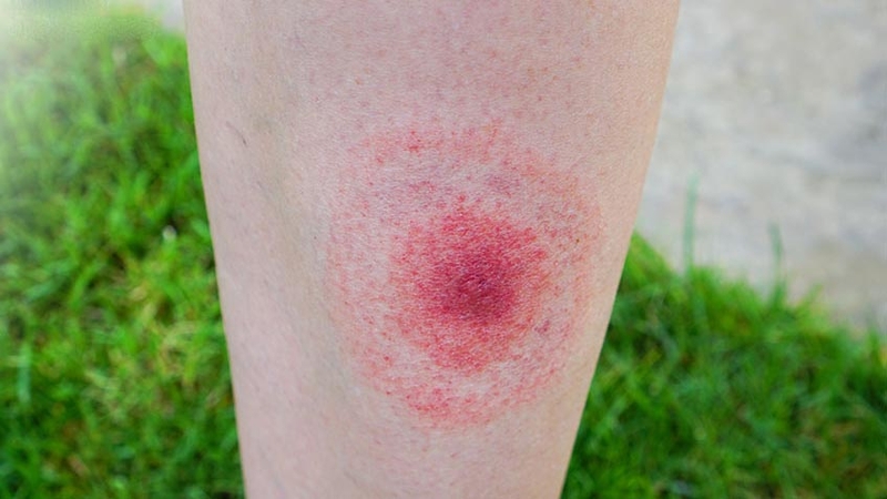 Nước tiểu màu trắng đục là bị bệnh gì?  2