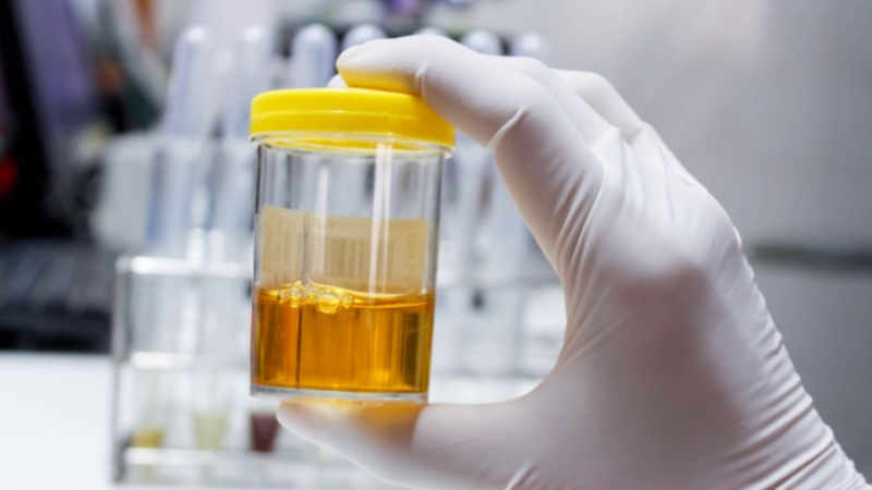 Nước tiểu sẫm màu do nguyên nhân nào gây nên? 1