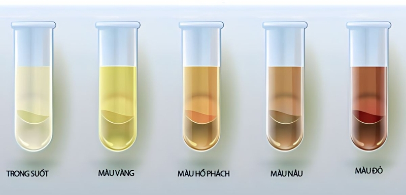 Nước tiểu trong suốt phản ánh tình trạng sức khỏe tốt hay xấu? 4
