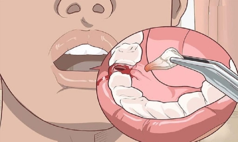 Nuốt phải máu sau khi nhổ răng có sao không? Cách xử lý và phòng ngừa tình trạng này 1