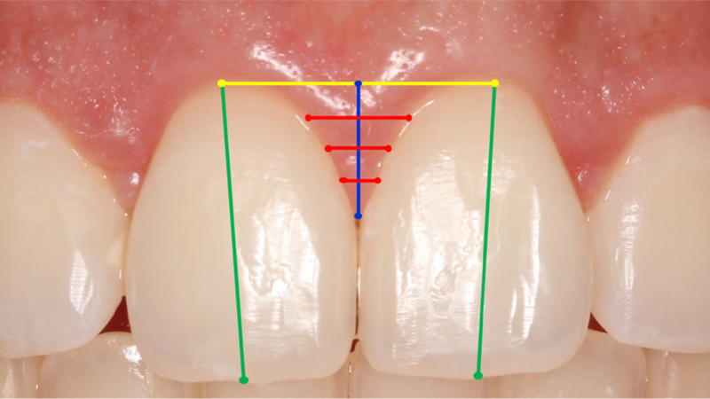 Nướu răng là gì? Cấu tạo, chức năng và các bệnh liên quan 1