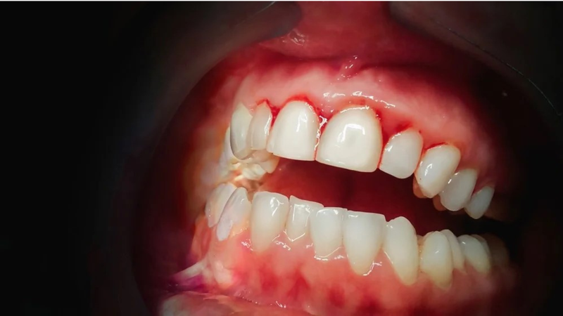 Nướu răng là gì? Cấu tạo, chức năng và các bệnh liên quan 5