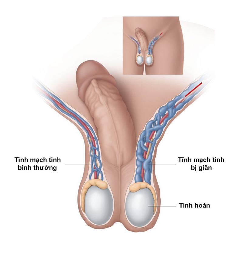 Ở nam giới, giãn tĩnh mạch thừng tinh uống thuốc có khỏi không? - 1