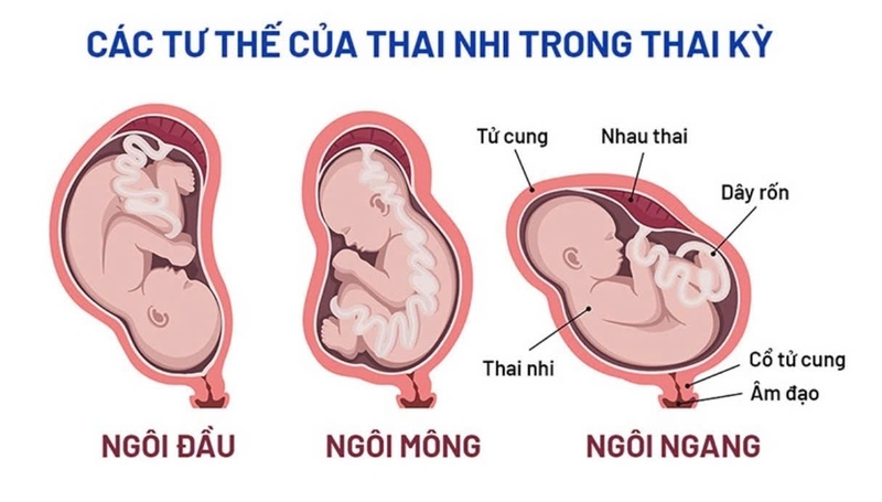 Ối rỉ non: Nguyên nhân, hướng xử trí và cách phòng ngừa 4
