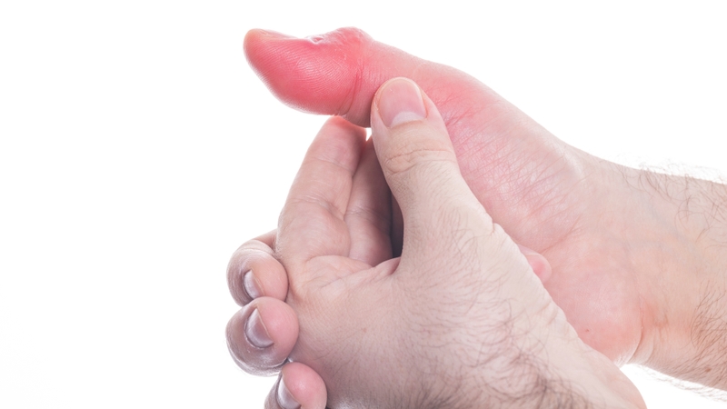 Ong bầu có độc không? Cách xử lý khi bị đốt an toàn và hiệu quả 3