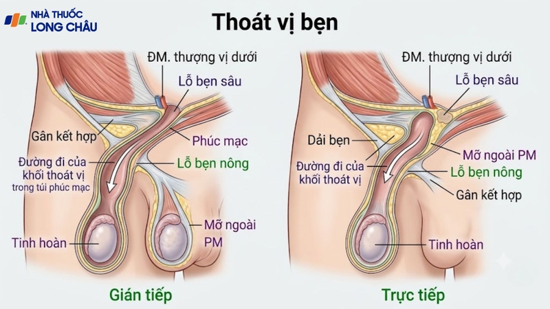 Thoát vị bẹn gây khối phồng vùng bẹn, thường rõ hơn khi ho hoặc rặn