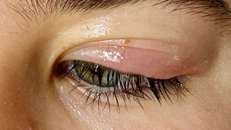 Nọc ong có thể gây ra hàng loạt biến chứng nghiêm trọng do vùng mắt vô cùng nhạy cảm