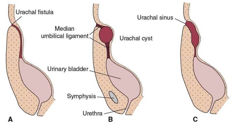 Nang niệu rốn là một khối u nang hình thành khi ống niệu rốn không đóng lại