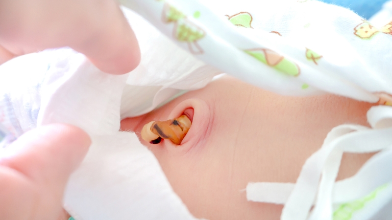 Dịch rỉ ra từ rốn của trẻ khi bố mẹ ấn vào vùng trên xương mu