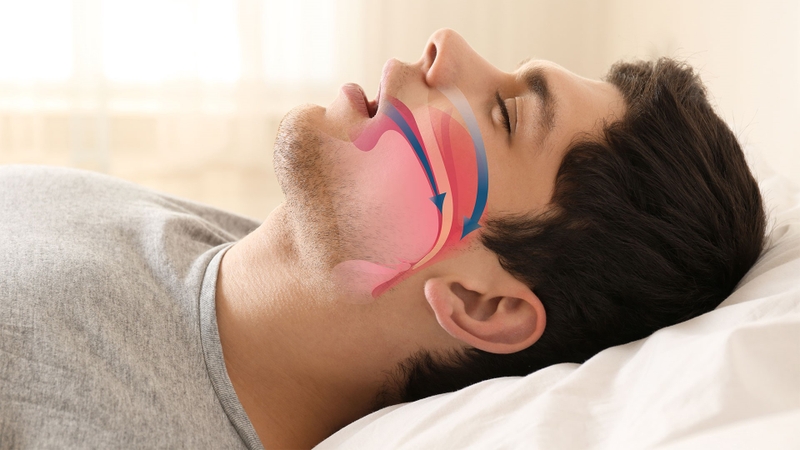 OSA là gì và cách xử lý OSA 1