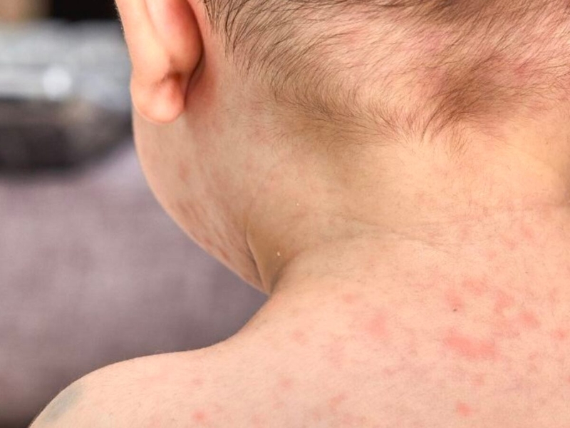 Tác dụng phụ do Panadol gây ra có thể bị phát ban da