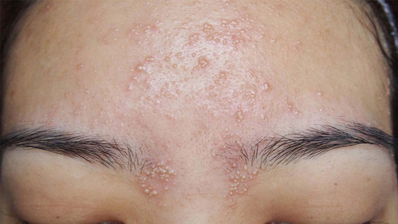 Peel da bị nổi mụn nước: Nguyên nhân và cách khắc phục 1