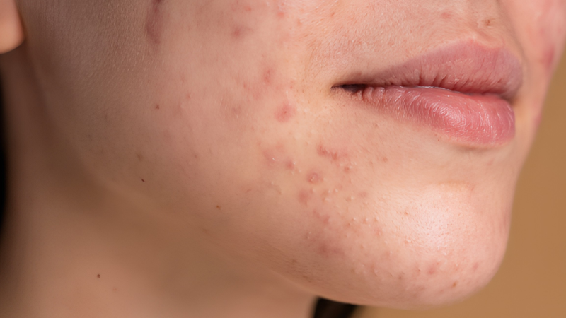 Người có mụn trứng cá nhẹ có thể cân nhắc peel da phù hợp
