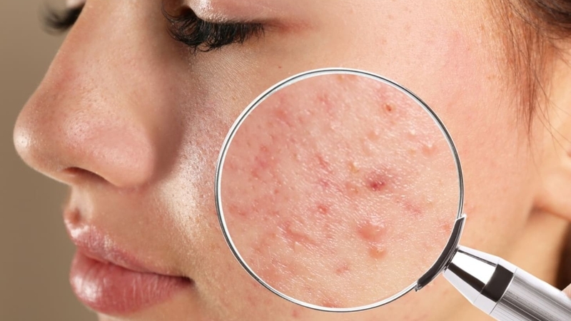 Có nhiều yếu tố ảnh hưởng đến thời gian mụn đẩy lên sau khi peel
