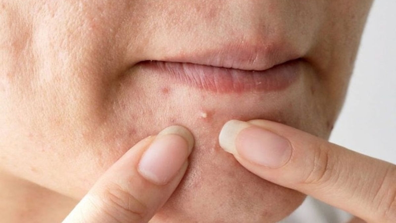 Sau khi peel da, cần chăm sóc da nhẹ nhàng hơn
