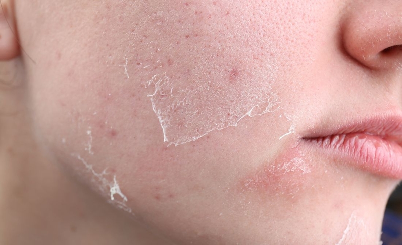 Peel da sau bao lâu thì đẹp? Cách giúp da nhanh tái tạo sau peel 2