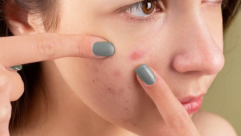 Peel da trị mụn có an toàn không? Có nên thực hiện không? 2