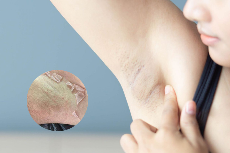 Peel da trị thâm nách là gì? Làm sao để peel da trị thâm hiệu quả? 2