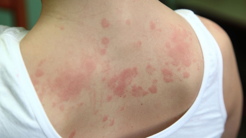 Penicillin là kháng sinh gì? Các triệu chứng dị ứng penicillin 3