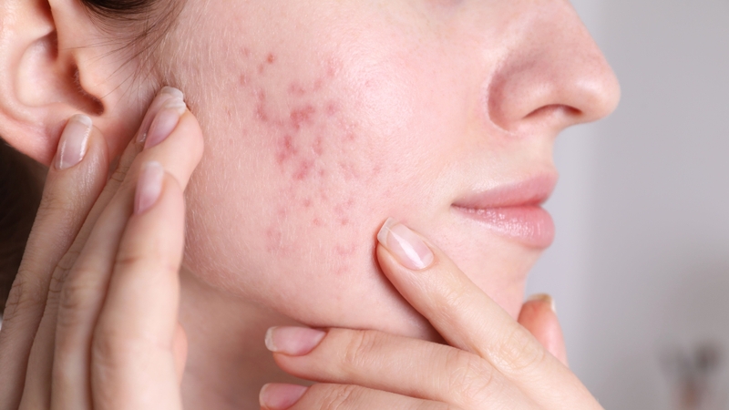 PHA loại bỏ lớp tế bào chết bề mặt, hỗ trợ làm đều màu da, giảm thâm và vết sạm