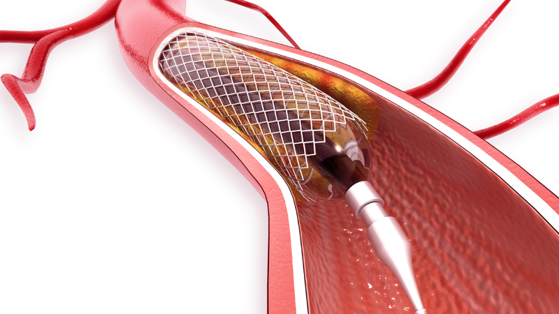 phac-do-dieu-tri-dau-that-nguc 4