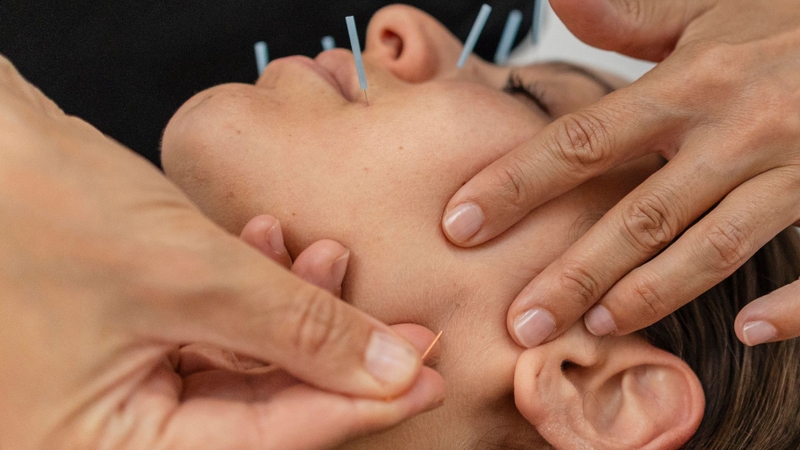 Châm cứu là phương pháp điều trị không dùng thuốc thường được sử dụng