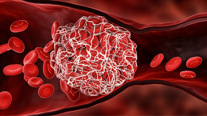 Phác đồ điều trị nhồi máu não Bộ Y tế 1