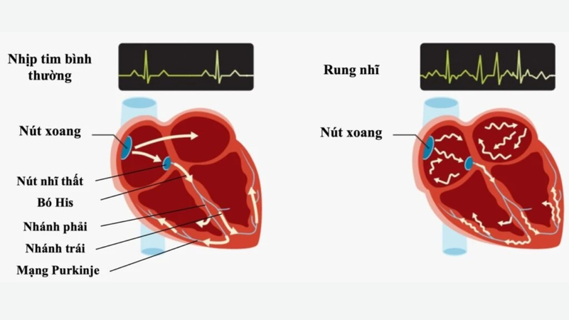Phác đồ điều trị rung nhĩ như thế nào? Những lưu ý người bệnh cần nắm 2
