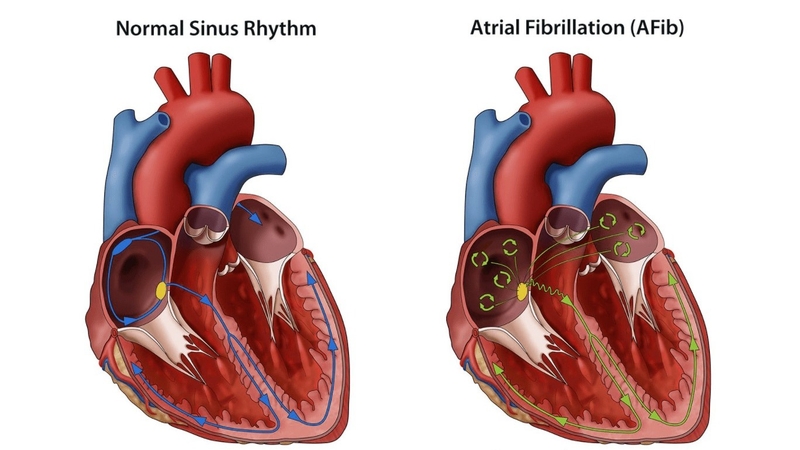 Phác đồ điều trị rung nhĩ như thế nào? Những lưu ý người bệnh cần nắm 1