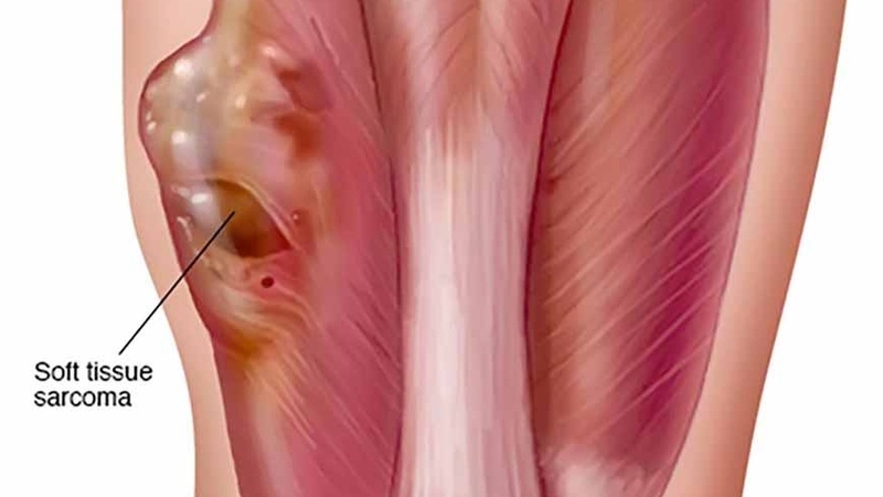 Phác đồ điều trị Sarcoma như thế nào? 1