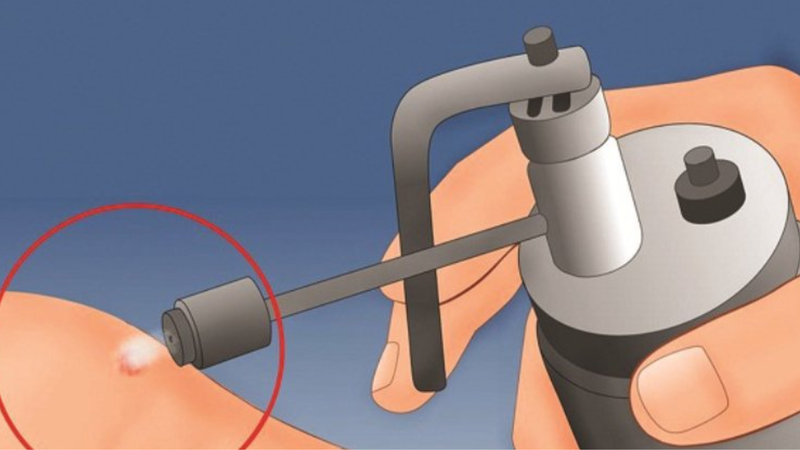 Phác đồ điều trị sùi mào gà Bộ Y tế 2