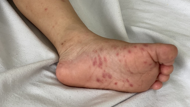 Tìm hiểu phác đồ điều trị tay chân miệng Bộ Y tế 1