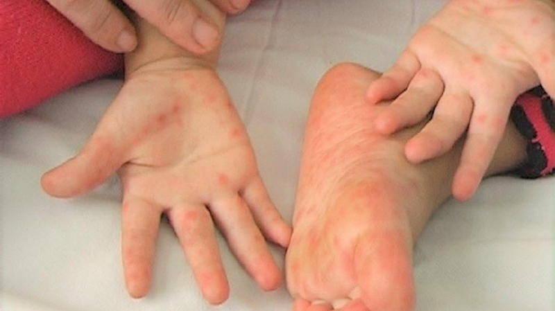 Tìm hiểu phác đồ điều trị tay chân miệng Bộ Y tế 2