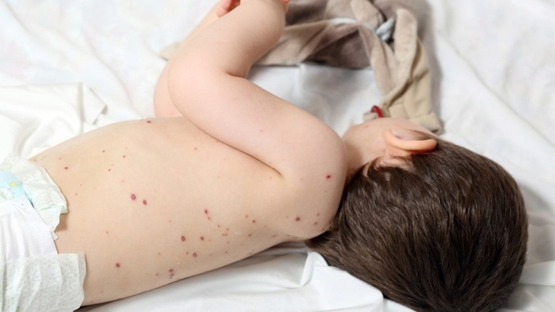 Phác đồ điều trị thủy đậu ở trẻ em bố mẹ cần biết 3