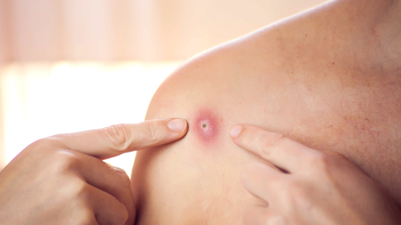 Phác đồ điều trị tụ cầu vàng như thế nào? 2