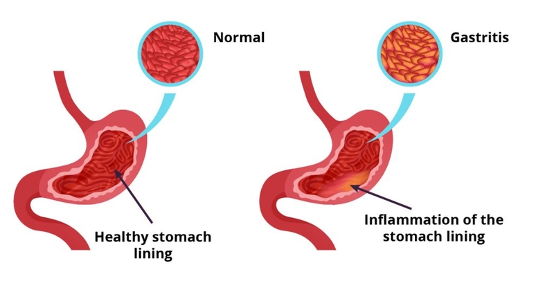 Phác đồ điều trị viêm dạ dày mạn tính và cách phòng ngừa 2