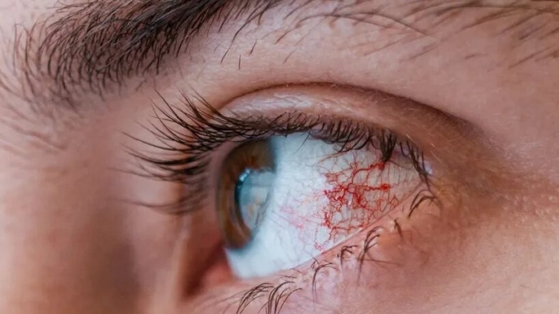 Phác đồ điều trị viêm kết mạc Bộ Y tế 2