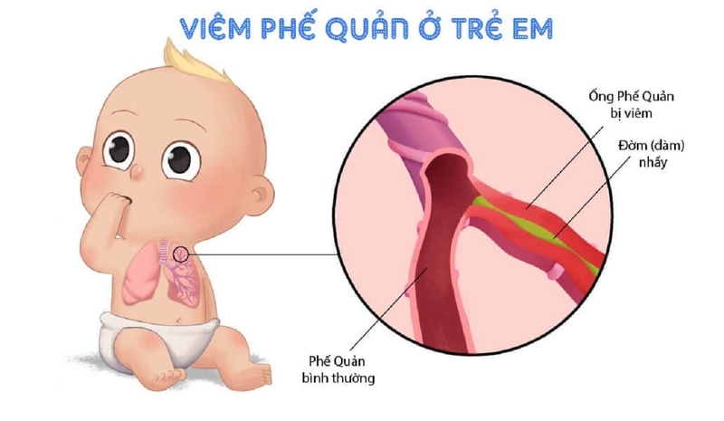 Phác đồ điều trị viêm phế quản ở trẻ em và cách chăm sóc trẻ bệnh 1