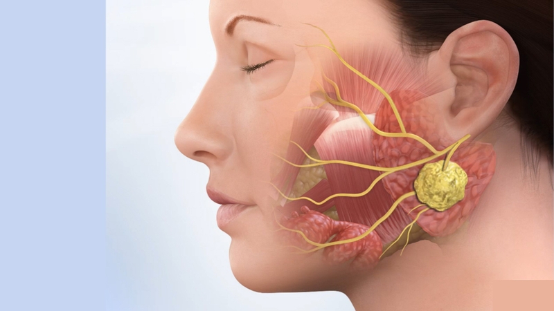 Tìm hiểu phác đồ điều trị viêm tuyến nước bọt mang tai  1