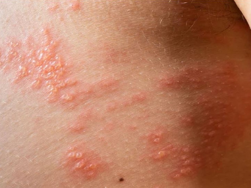 Phác đồ điều trị zona 1