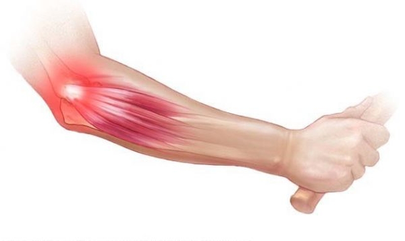 Phải làm gì khi bị trật khớp khuỷu tay?1