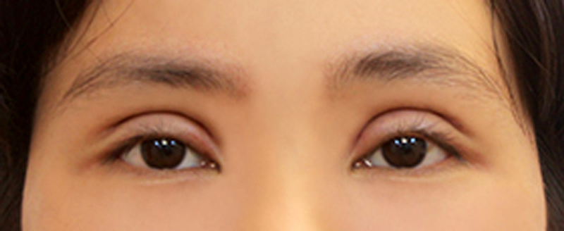 Phải làm gì khi cắt mí bị trợn? 2