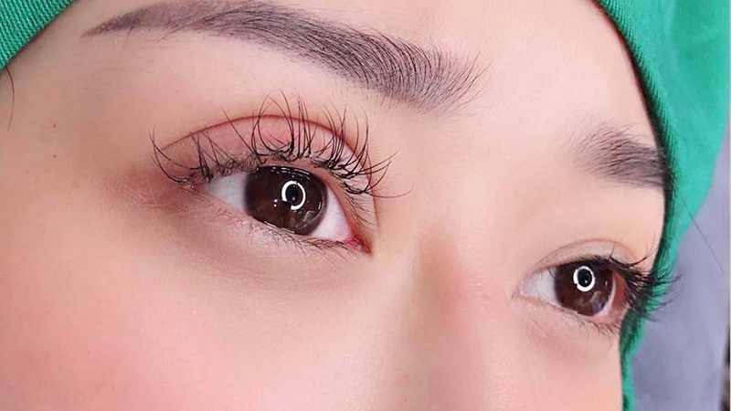 Phải làm gì khi cắt mí bị trợn? 1