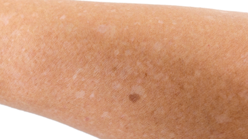 Phải làm sao khi da bị chấm trắng do ngộ độc nắng 1