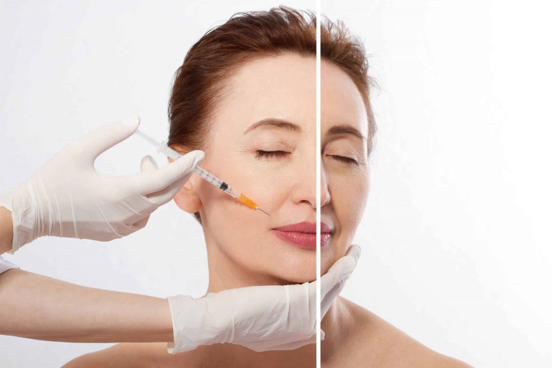 Phân biệt 2 phương pháp làm đẹp: tiêm filler - botox 1