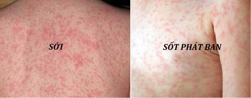 Phân biệt 3 dạng phát ban ở trẻ: sởi, sốt phát ban và Rubella